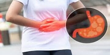 GERD - Gejala, Penyebab dan Pengobatan