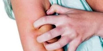 Penyebab Badan Gatal-gatal Bentol Tanpa Sebab dan Cara Mengatasinya