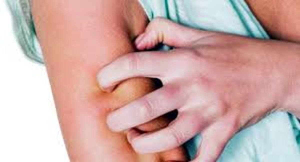 Penyebab Badan Gatal-gatal Bentol Tanpa Sebab dan Cara Mengatasinya